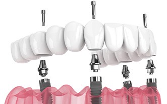 Digital image of an implant denture 