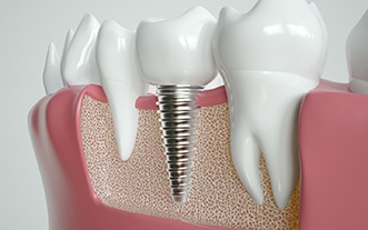 Dental implant in Glastonbury, CT fusing with jawbone