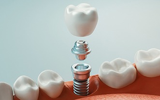 Illustration of dental implant in Glastonbury, CT with crown being placed