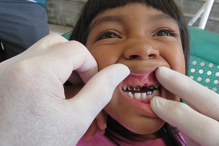 Dentist examining child's severely decayed teeth