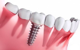 diagram showing the health benefits of dental implants