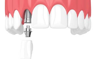 Model showing parts of dental implant
