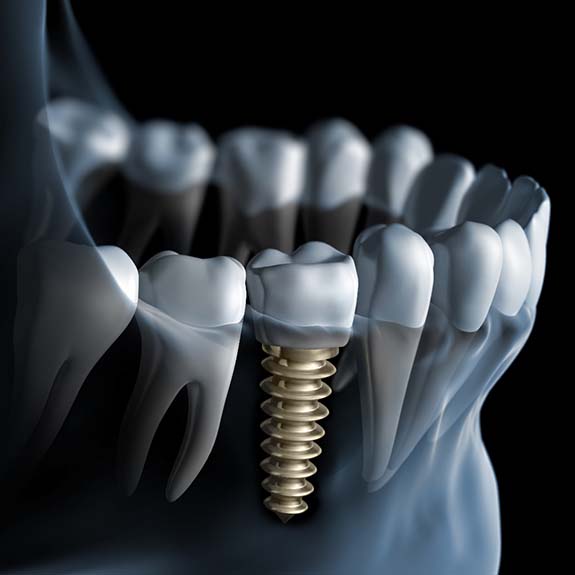 X-ray diagram of dental implants in Glastonbury