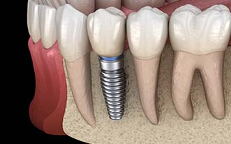 Diagram of a single tooth dental implant in Glastonbury