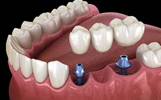 Diagram of implant bridge replacing multiple missing teeth in Glastonbury