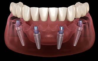 Diagram of implant dentures in Glastonbury