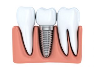 You might be a candidate for dental implants in Glastonbury.