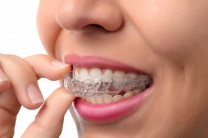 Woman inserting clear aligner into her mouth. 