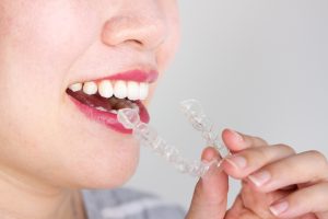 Woman with a clear plastic aligner.