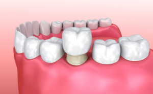 a closeup of a temporary dental crown 