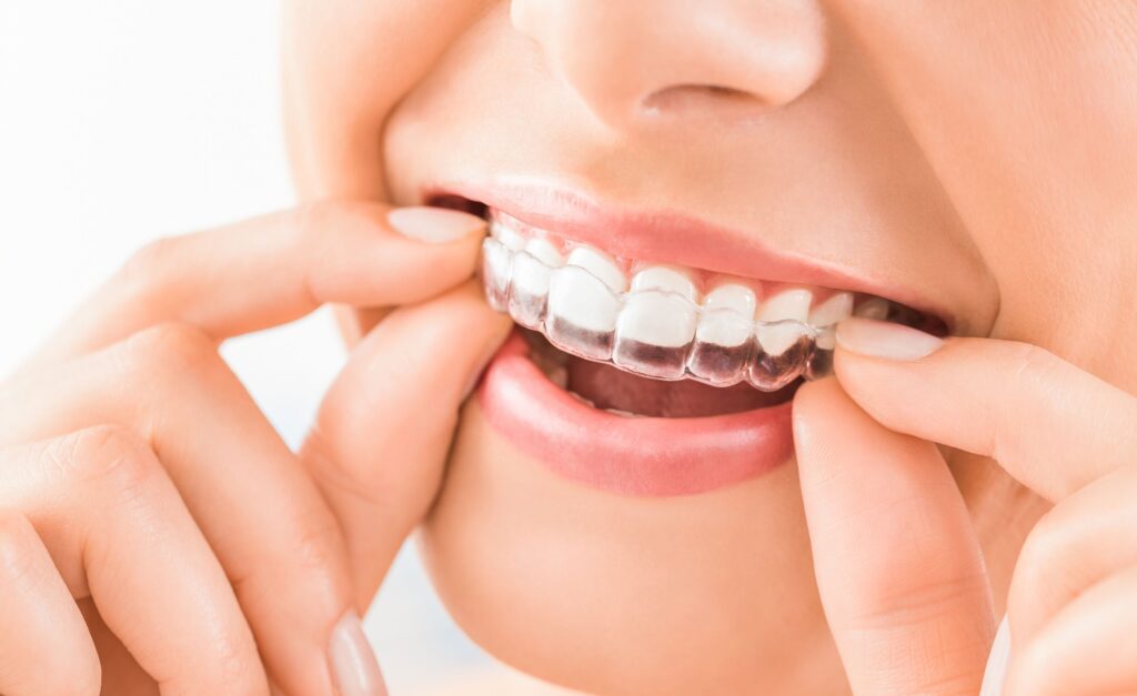 Nose-to-chin closeup of woman removing Invisalign from upper arch
