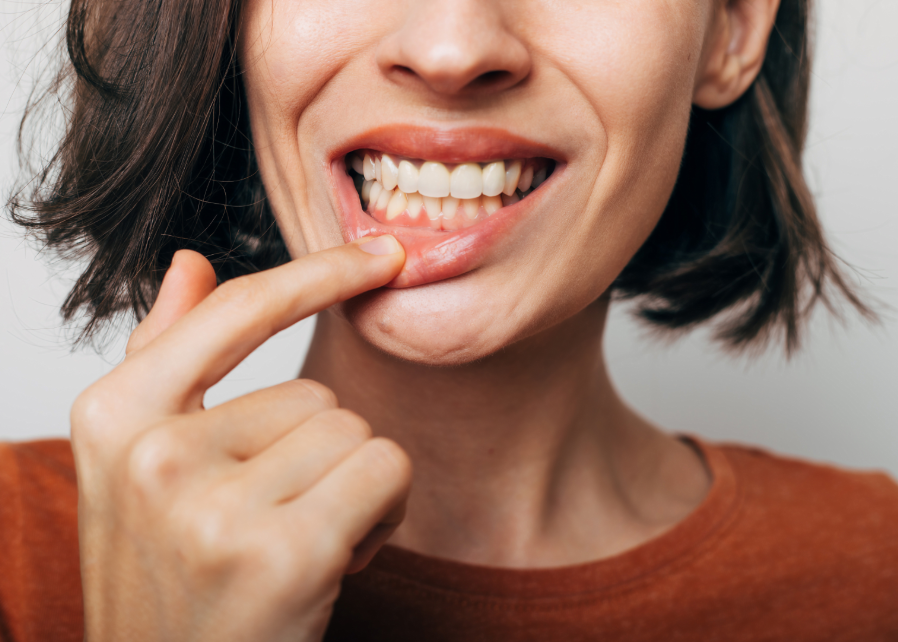 Woman pulling down lip to show gums